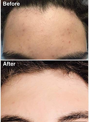 Teenology Conditioner for Teens - Avoid Forehead and Body Acne - Sulfate and Paraben Free, Noncomedogenic, Natural Botanical Extracts, Vanilla Almond - 16 oz.