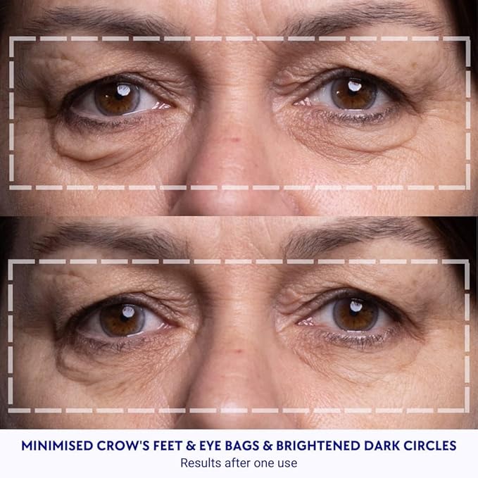 Wrinkles Schminkles Facial Smoothing Set | Mouth & Lip 2-Pack | Eye Wrinkle Patches 3-Pairs | Forehead Wrinkle Patches 2-Pack | Reusable Hypoallergenic Silicone Smoothing Pads
