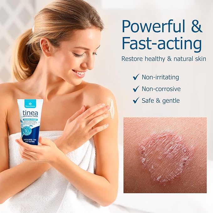 Roycederm Tinea Versicolor Treatment, Athletes Foot Treatment, Ringworm Treatment for Humans, for Tinea Versicolor & Pedis,Fast Healing Anti Fungal Skin Cream - Multi-Functional