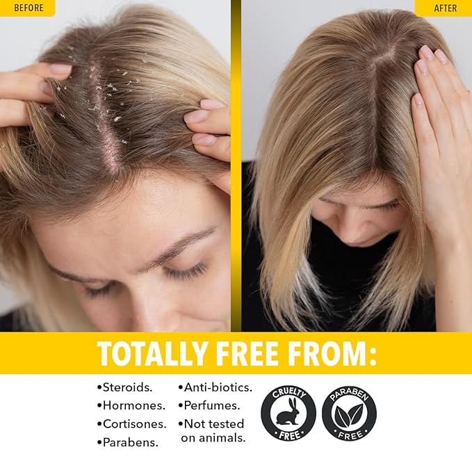 Dr. Robaina Sulfur Balsam Conditioner – Hydrating & Detangling Formula for Sensitive, Flaky or Itchy Scalp – Tea Tree & Shea Butter Blend – Color-Safe, Silicone-Free, 8 fl oz - Made in the USA