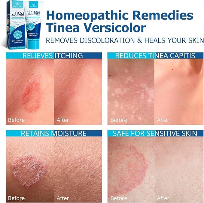 Roycederm Tinea Versicolor Treatment, Athletes Foot Treatment, Ringworm Treatment for Humans, for Tinea Versicolor & Pedis,Fast Healing Anti Fungal Skin Cream - Multi-Functional