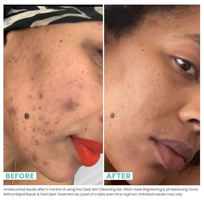 Urban Skin Rx® Witch Hazel Brightening & pH Balancing Toner, Exfoliated & Clarifies Clogged Pores, Improves The Appearance of Uneven Skin Tone, Reduces Redness & Brightens Dull Complexions, 4.5 Fl Oz