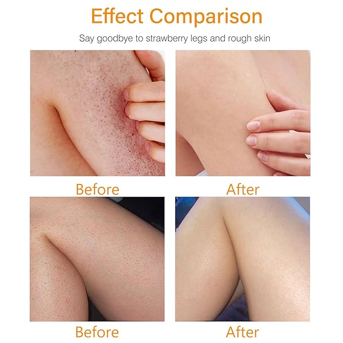 Strawberry Skin Treatment– Strawberry Legs Resurfacing Cream, Ultra Strength Exfoliating Body Lotion for Rough & Bumpy Skin, Body Care moisturizer for Women (2)