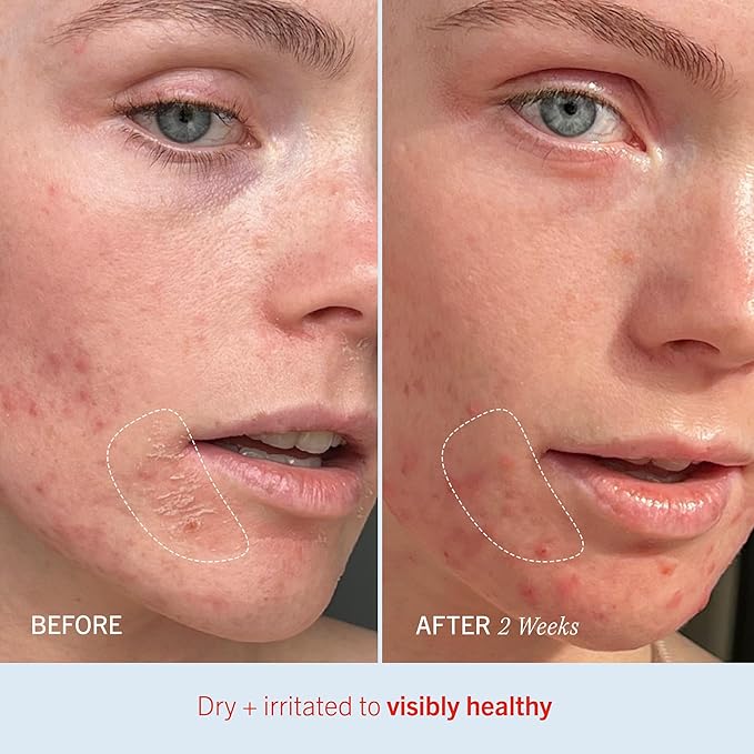 First Aid Beauty - Ultra Repair Cream, Intense Hydration Whipped Colloidal Oatmeal, Clinically Proven to Strengthen Skin Barrier in 7 Days & Helps Relieve Eczema, Luxury Moisturizer, 2 oz, 3 ct