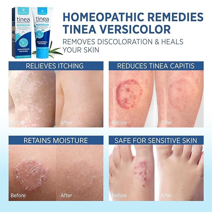 Roycederm Tinea Versicolor Treatment, Athletes Foot Treatment, Ringworm Treatment for Humans, for Tinea Versicolor & Pedis,Fast Healing Anti Fungal Skin Cream - Multi-Functional - Pack of 2